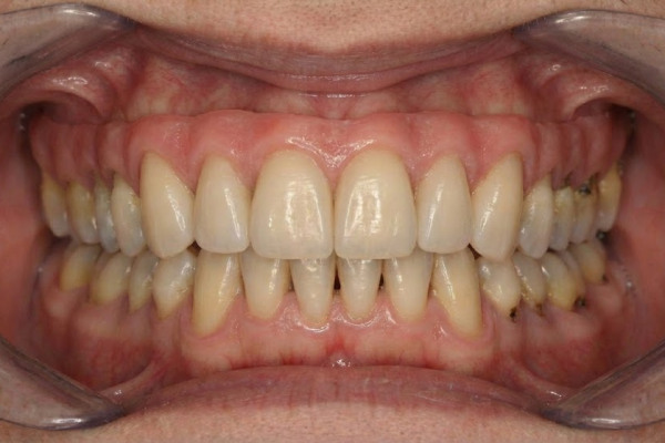 After: full upper arch restored with All-on-4