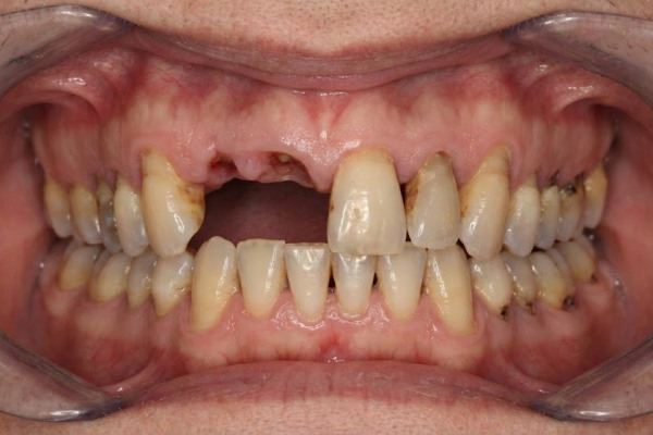 Before: patient with failing upper teeth