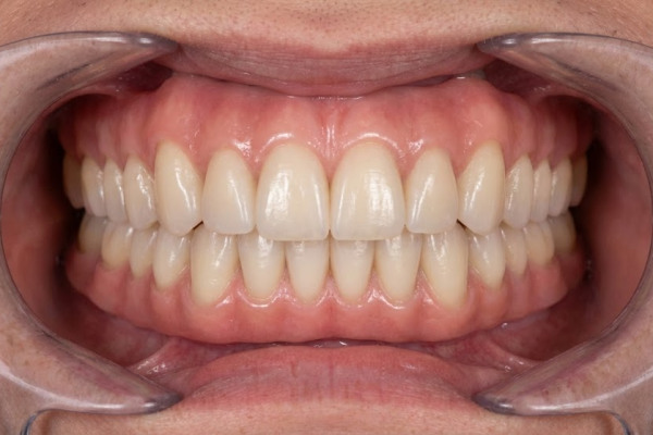 After: lower arch restored with All-on-4