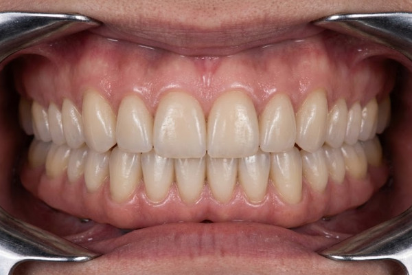 After: complete upper and lower restoration