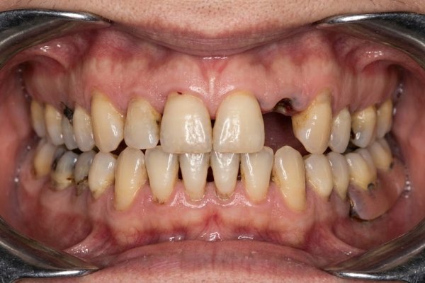 Before: patient needing complete restoration