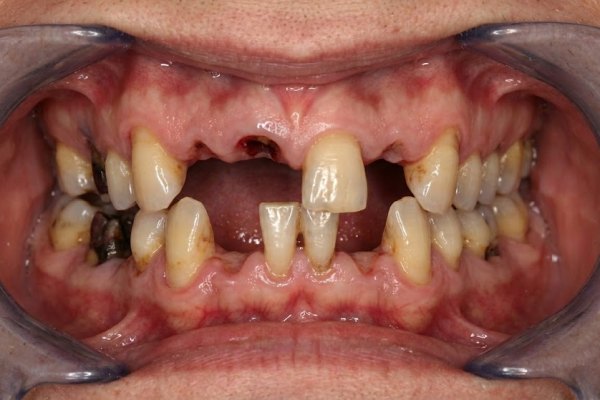 Before: patient with failing removable dentures