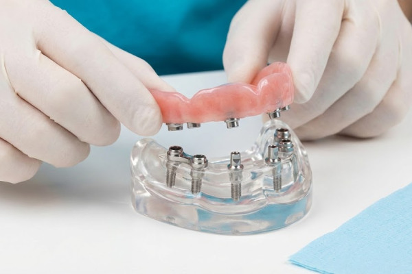 Snap-on overdenture prosthetic